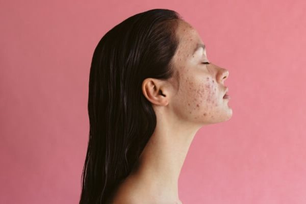 5 Cara Mengatasi Jerawat dengan Menyeimbangkan Hormon Anda 5 Cara Mengatasi Jerawat dengan Menyeimbangkan Hormon Anda