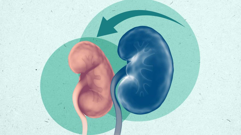 5 Langkah Pemulihan Setelah Mengalami Masalah Ginjal