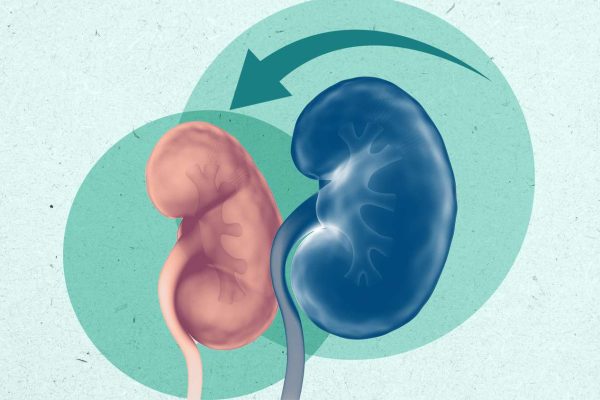5 Langkah Pemulihan Setelah Mengalami Masalah Ginjal