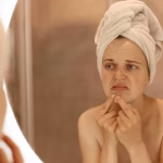 10 Kebiasaan Buruk yang Dapat Memperburuk Acne Anda