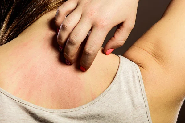 5 Cara Mencegah Alergi karena Bahan Pakaian 5 Cara Mencegah Alergi karena Bahan Pakaian