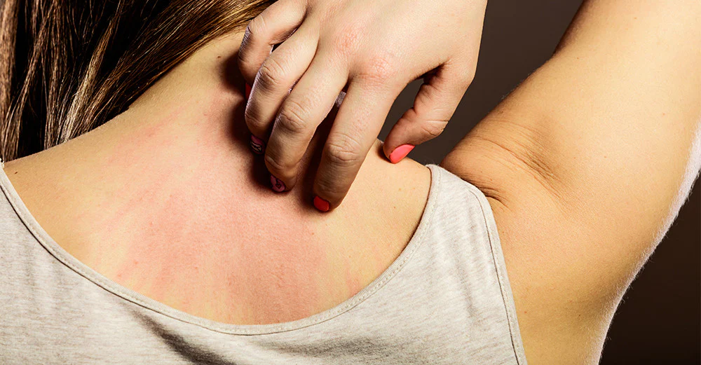 5 Cara Mencegah Alergi karena Bahan Pakaian