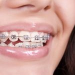 7 Tips Gigi Sehat buat Kamu yang Suka Pakai Behel