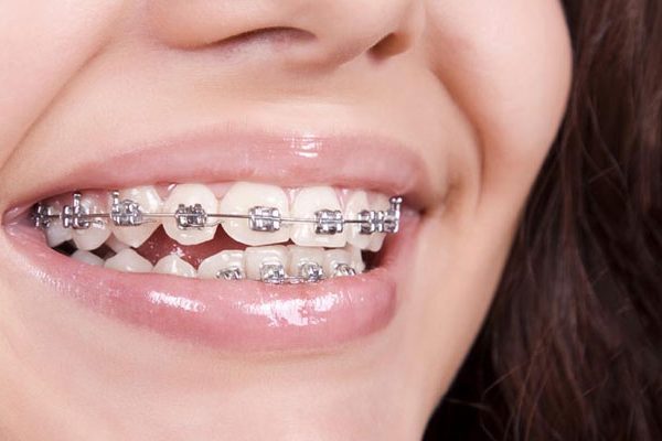 7 Tips Gigi Sehat buat Kamu yang Suka Pakai Behel 7 Tips Gigi Sehat buat Kamu yang Suka Pakai Behel