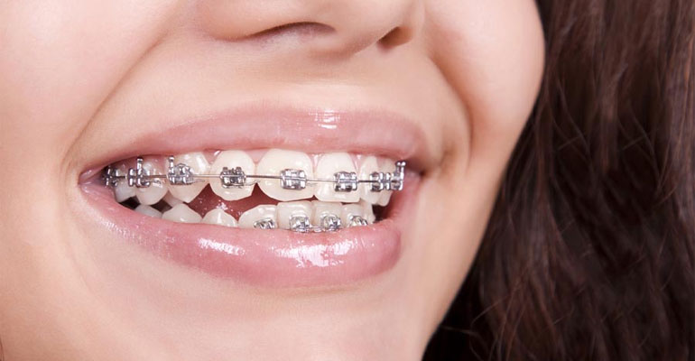 7 Tips Gigi Sehat buat Kamu yang Suka Pakai Behel