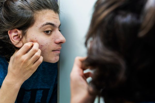 7 Tips Biar Gak Tergoda Mencetin Jerawat 7 Tips Biar Gak Tergoda Mencetin Jerawat