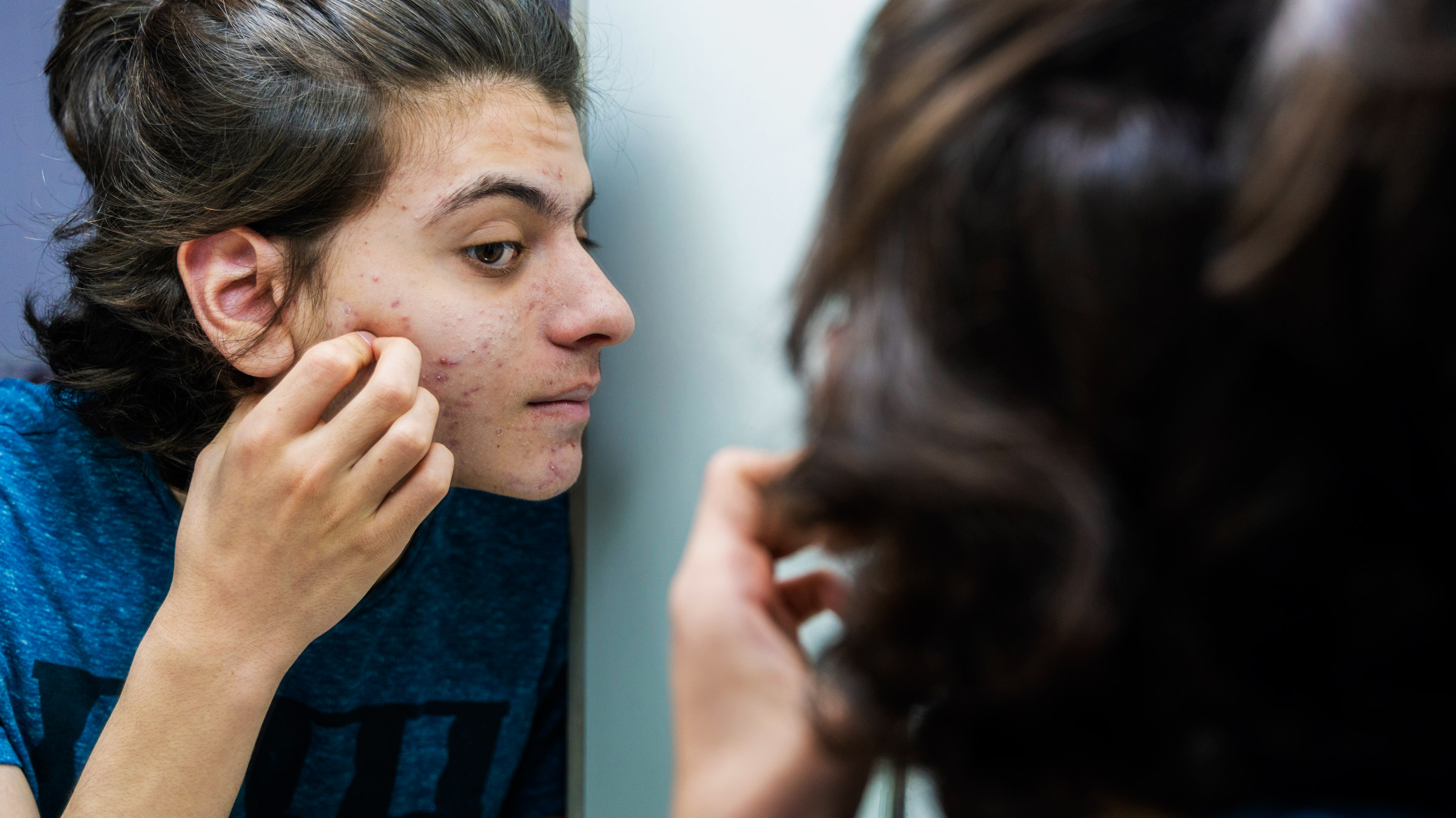 7 Tips Biar Gak Tergoda Mencetin Jerawat