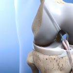 7 Cara Menguatkan Ligamen Lutut Secara Alami