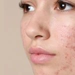 10 Tips Merawat Kulit Berminyak agar Tidak Berjerawat
